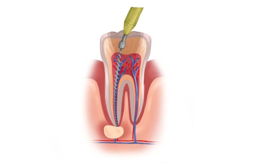 Illustration of a tooth receiving root canal therapy to treat an infection